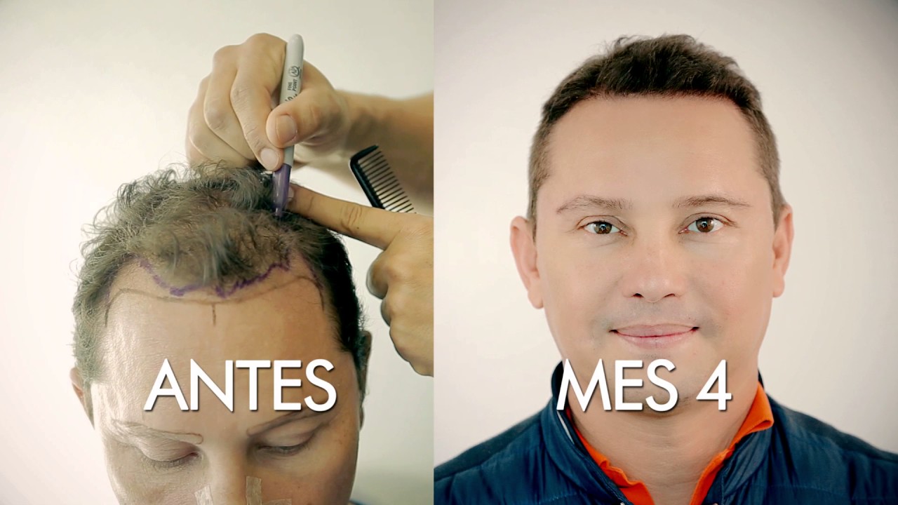 Trasplante Capilar Giovanny Ayala - Episodio 2