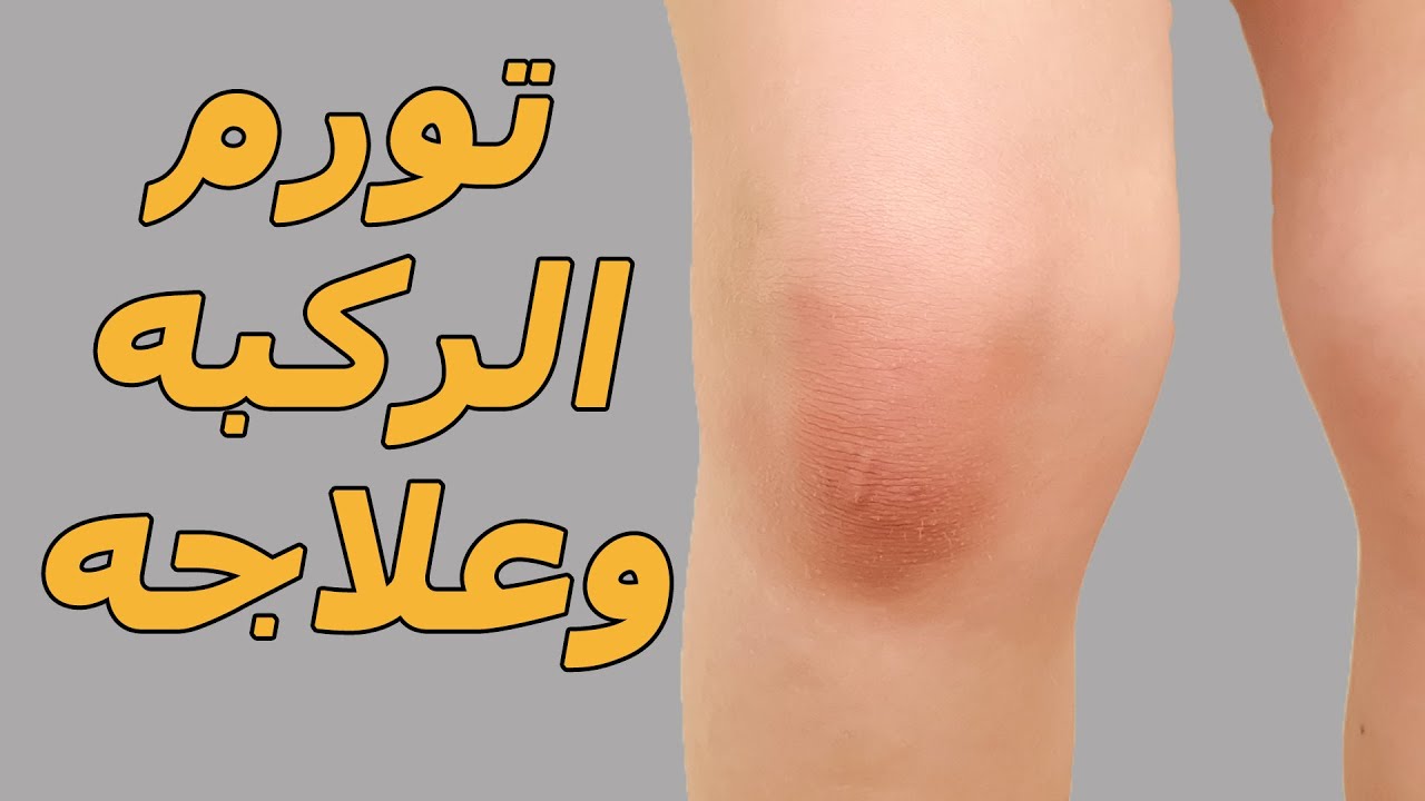 تورم الركبه وعلاجه /بخمس خطوات تخلص من تورم وألم الركبتين تماما/اسباب وعلاج تجمع السوائل فى الركبه