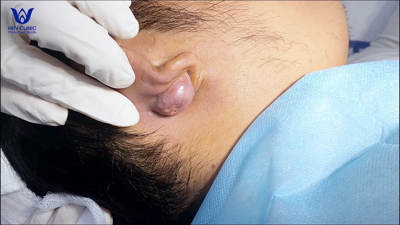 Tổng hợp nặn những ca mụn sưng vi&ecirc;m, nhiều dịch mủ trắng.