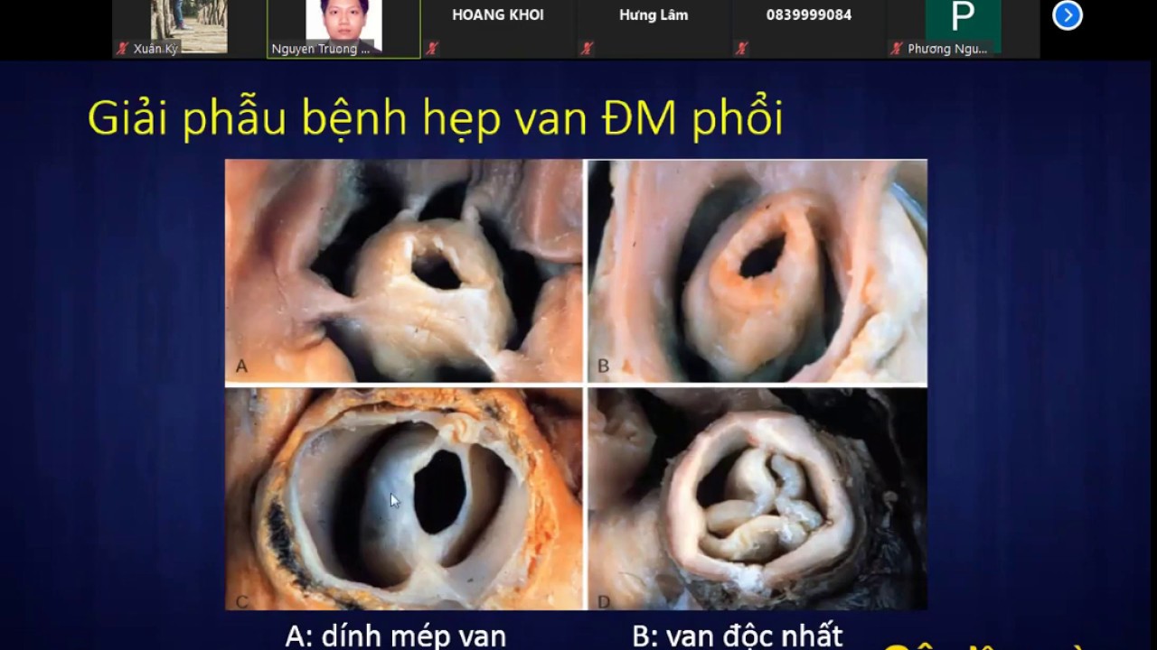 HẸP VAN ĐỘNG MẠCH PHỔI | ThS. BS. Nguyễn Trường Duy
