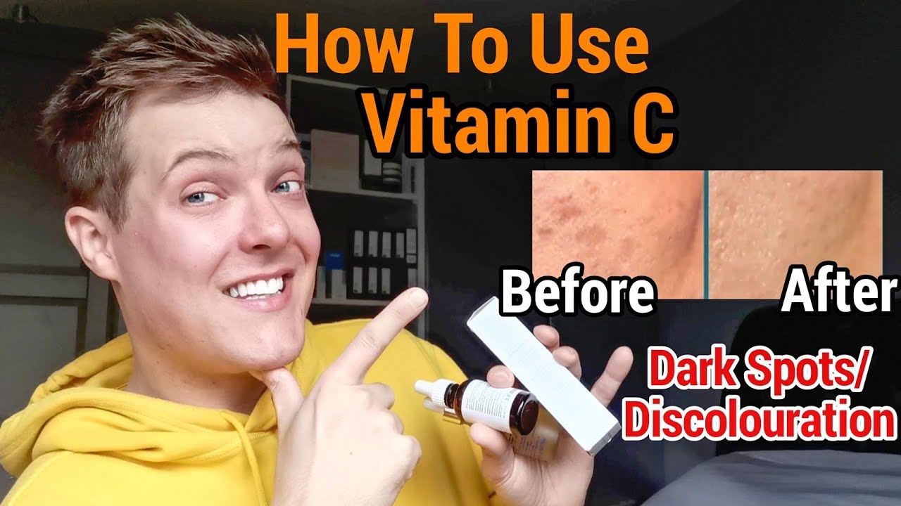 VITAMIN C For HYPERPIGMENTATION / The Best Vitamin C Serums