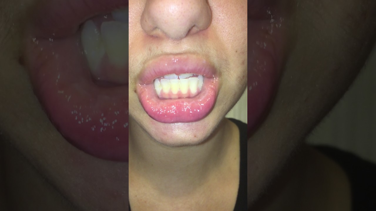 Exfoliative Cheilitis - Clobetasol - POST APPLICATION - Day 8 July 17 2017