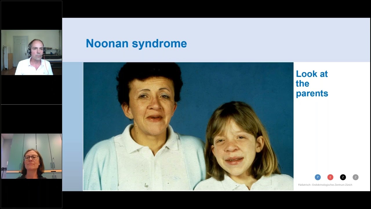 Noonan syndrome:  current guidelines regarding growth, endocrinology and growth hormone therapy
