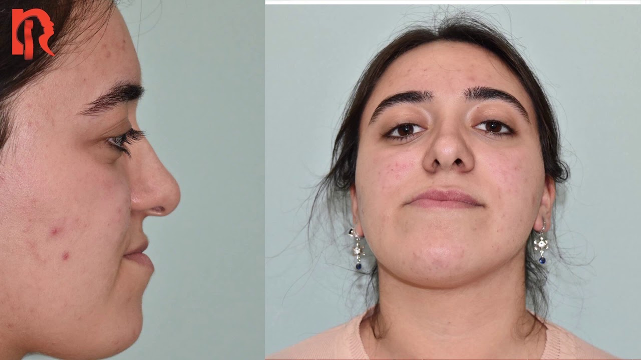 Bir Çene Estetiği Öyküsü & Çene Ameliyatı Öncesi ve Sonrası