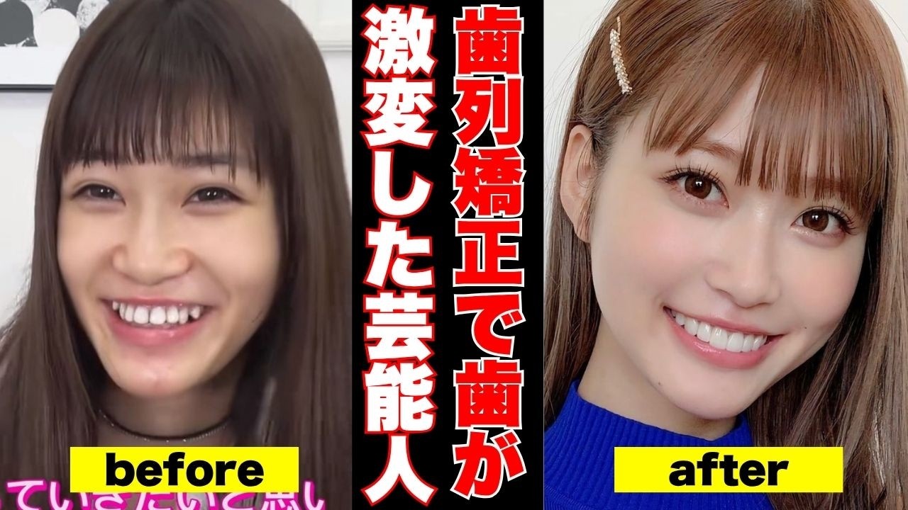 【衝撃変化】歯並び矯正した芸能人のビフォーアフター【ガルちゃん芸能】