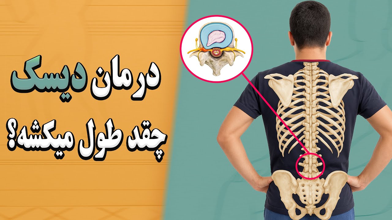 بیرون‌زدگی دیسک تا کی طول می‌کشه خوب بشه؟ | واقعیت بدون سانسور