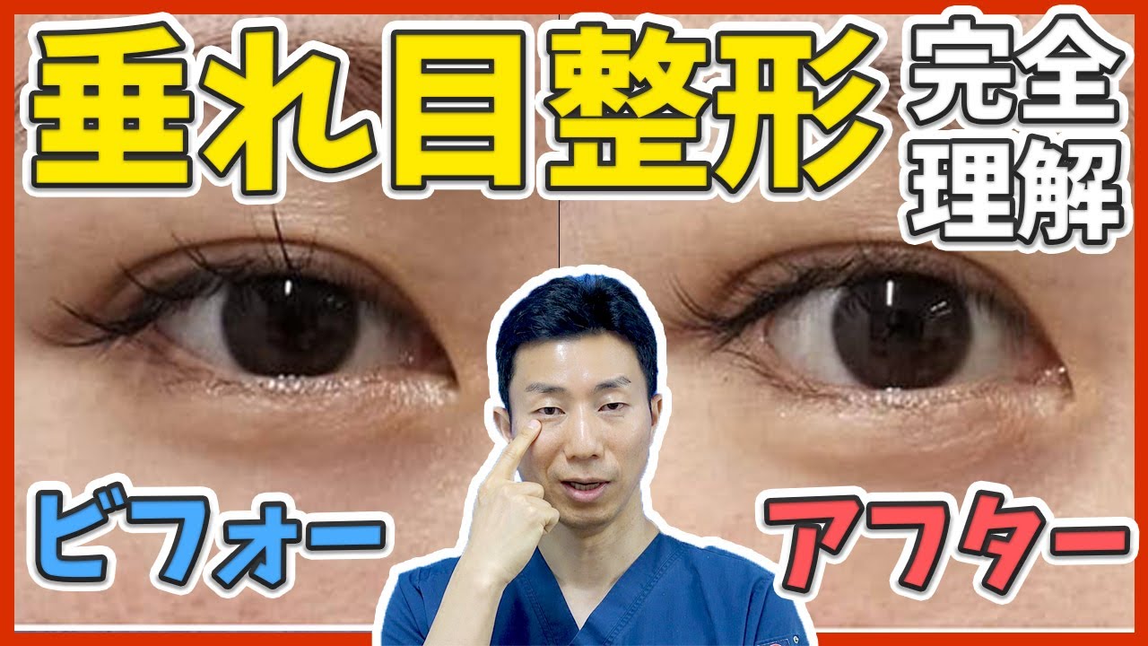 切らないたれ目整形と切開するタレ目整形のメリット・デメリットやダウンタイム - 症例写真付きで解説【デカ目効果も】