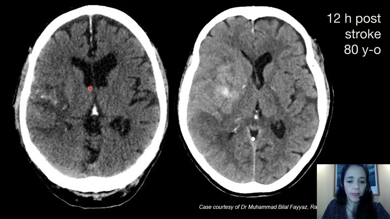 Use of Xa inhibiting agents    A neurologist perspective