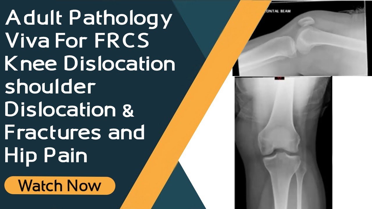 Adult Pathology Viva For FRCS | Knee Dislocation , shoulder Dislocation & Fractures and Hip Pain