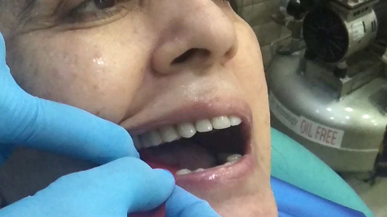 Occlusion check with 8 microns articulating paper