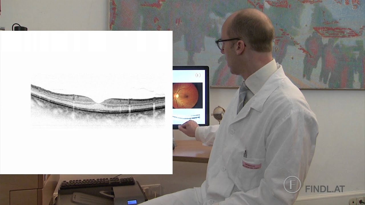 Epiretinal Membrane, Macular Pucker - Prof. Findl, Vienna