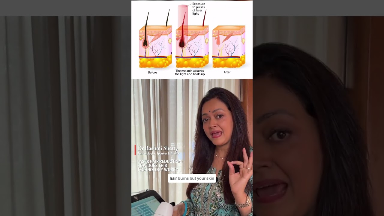 Lasers Hair Reduction: How does it really work?  By Dr Rashmi Shetty
