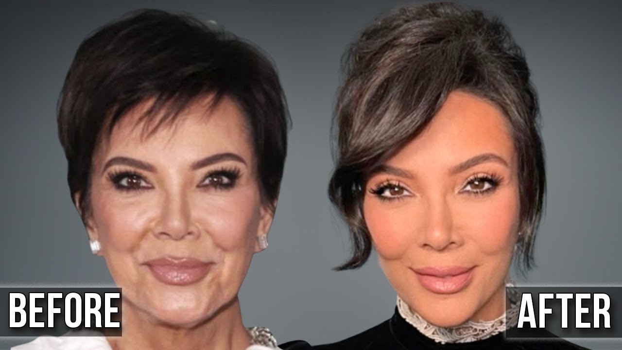 Kris Jenner’s New Face: The Procedures No One Is Talking About