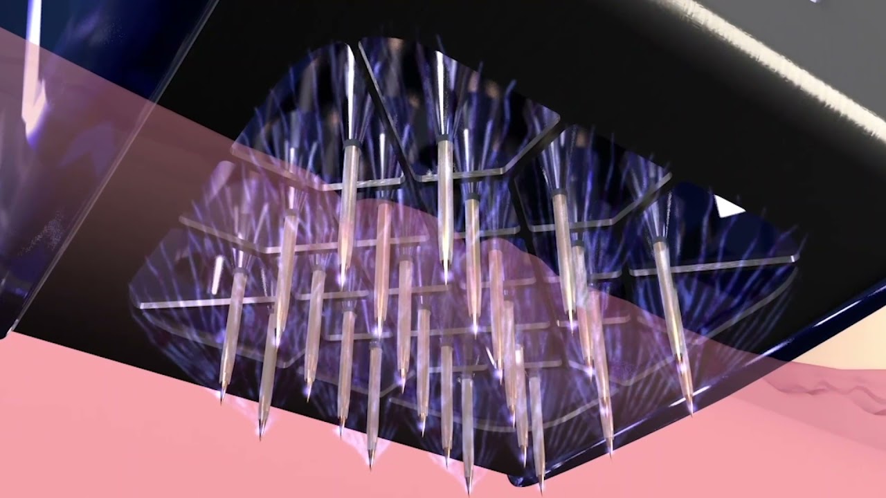 Morpheus 8 Skin Resurfacing