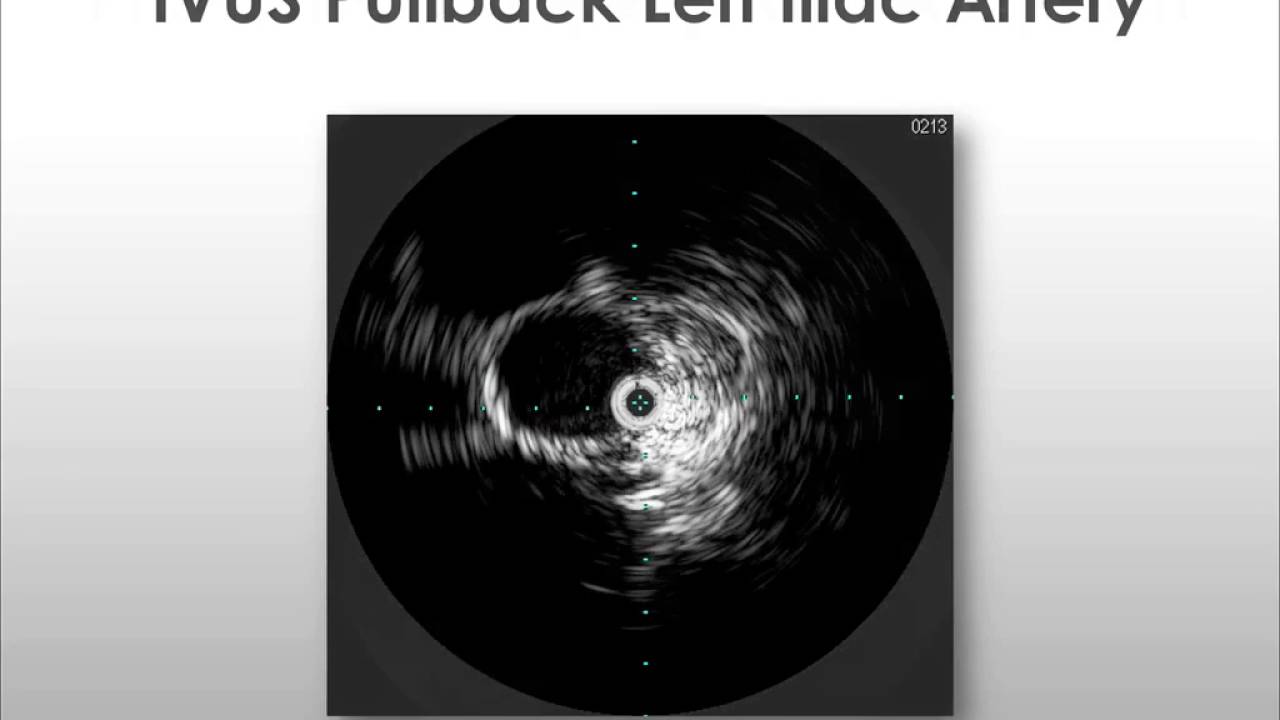 Dr. Tuchek - EVAR with IVUS Case Study #1