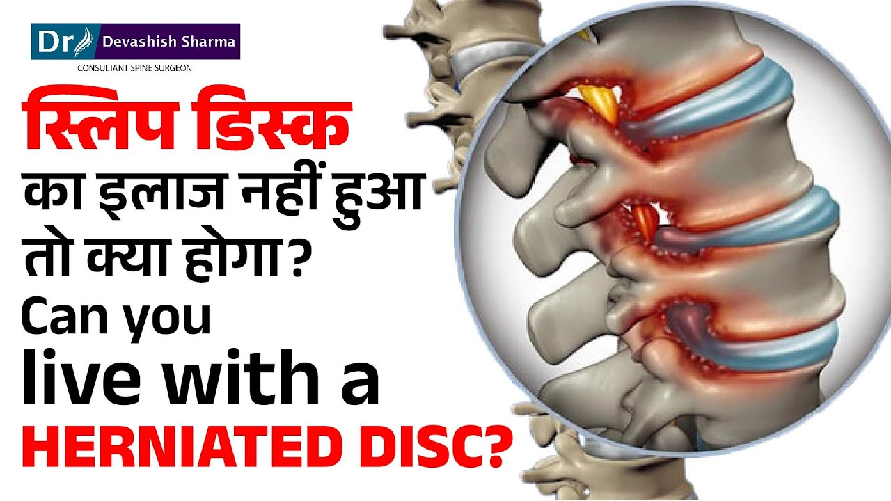 Can You Live With Herniated Discs Without Surgery? Slip Disc Treatment In Delhi, India -Dr Devashish