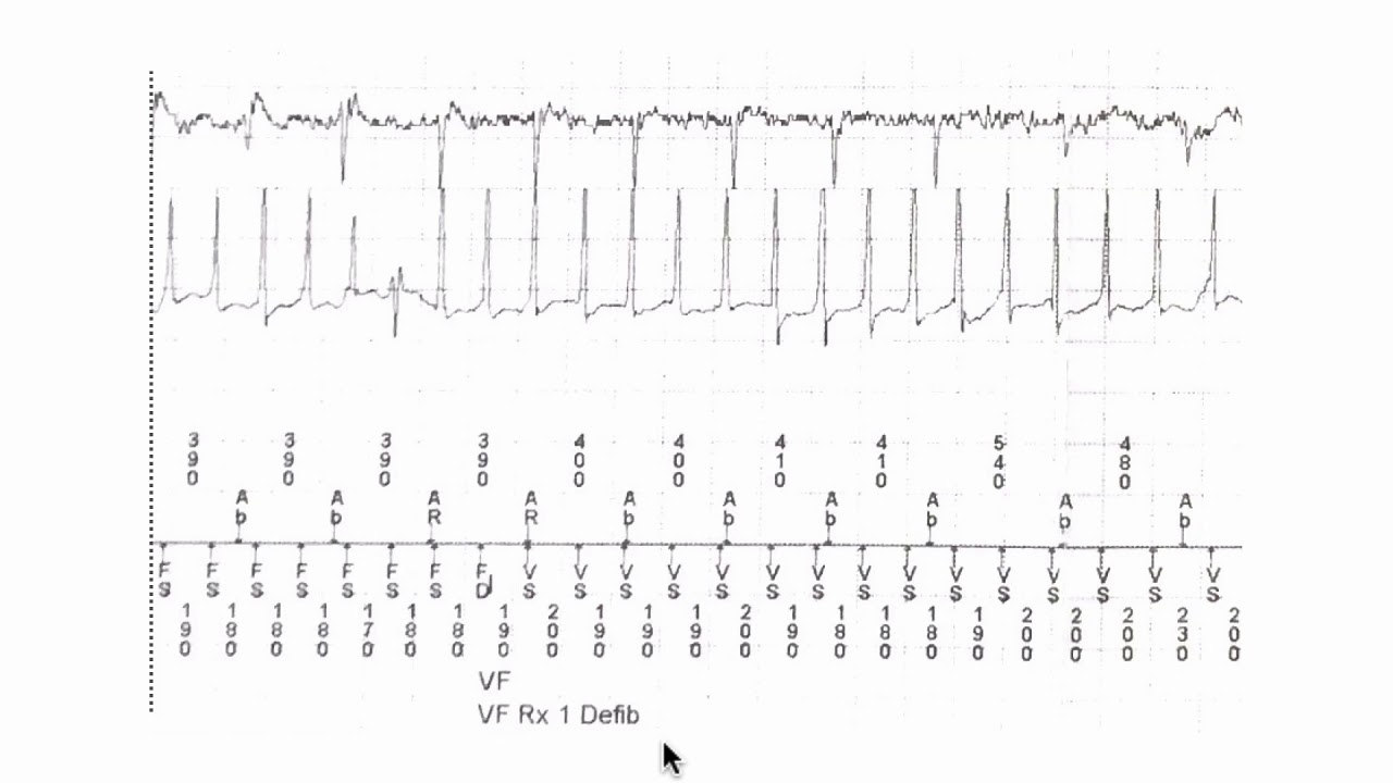 Understanding markers and annotations on an ECG.