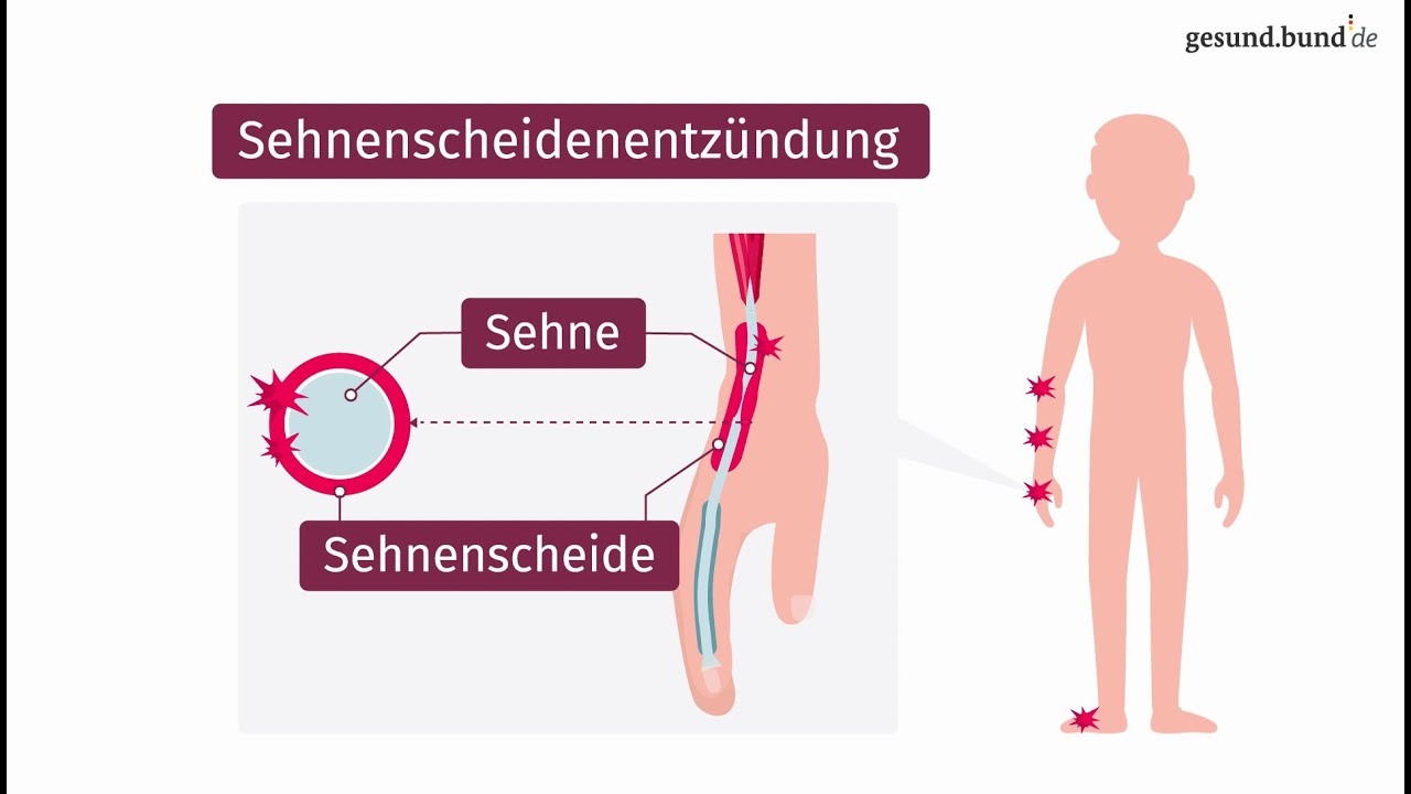 Was ist eine Sehnenscheidenentzündung?