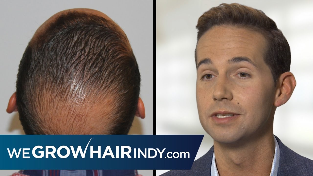 Crown Hair Loss Hair Transplant | PAI Medical Group of Indiana - Chris