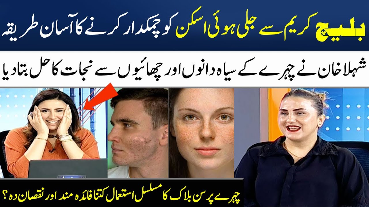 How to Remove Dark Spots & Pimples on Face? | Bleach Skin Burn Treatment | Madeha Naqvi | SAMAA TV