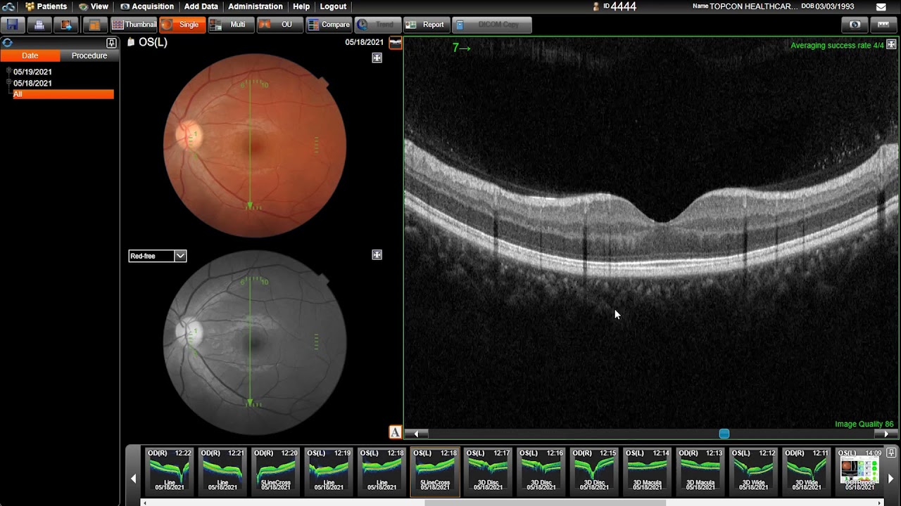 Topcon Maestro2: Retina Specific Scan