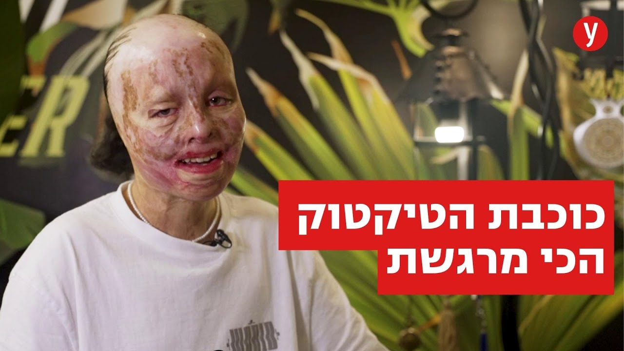 רביד נשרפה בכל גופה וחושפת הכול בטיקטוק: 