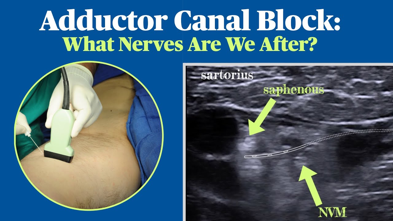 Adductor Canal Block: What Nerves Are We After?