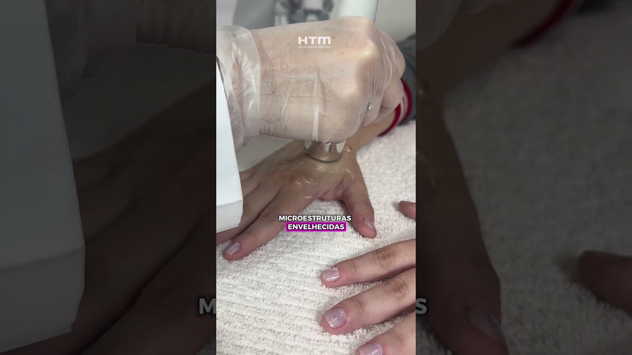 Rejuvenescimento das mãos com Ultrassom de 5MHz | Hibridi da HTM