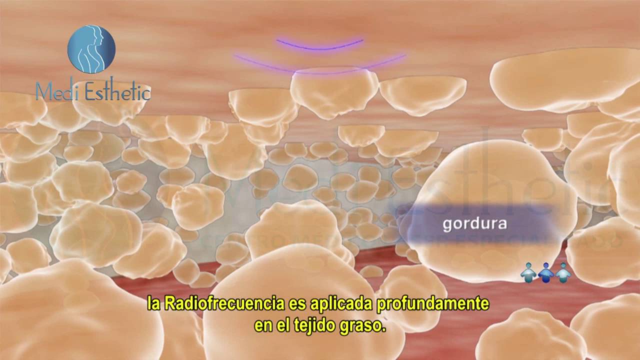 ¿Qué es la Radiofrecuencia?