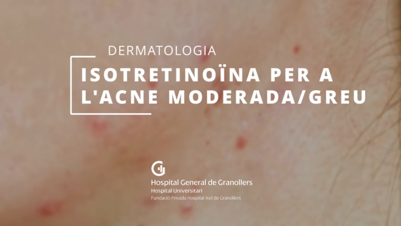Isotretinoïna per a l'acne moderada greu