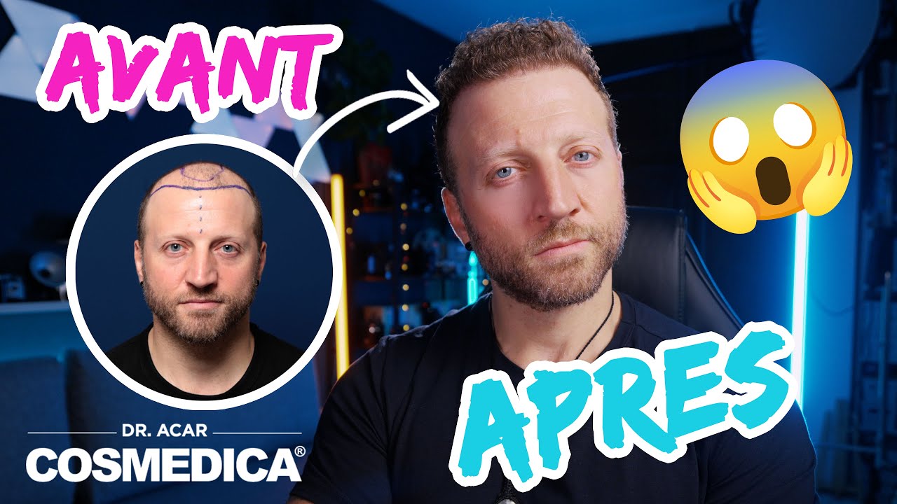 Ma Greffe de cheveux 11 mois plus tard - COSMEDICA CLINIC ISTAMBUL