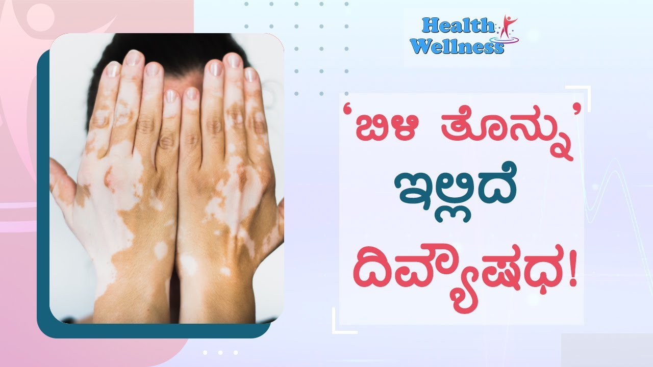 ಮುಜುಗರ ಉಂಟುಮಾಡುವ ತೊನ್ನಿಗೆ ಇಲ್ಲಿದೆ ಪರಿಹಾರ.! | Home remedies for VITILIGO | GSS MAADHYAMA
