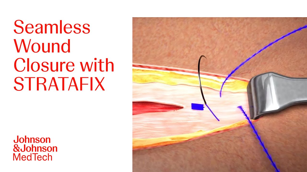 Step-by-Step Guide to Wound Closure using STRATAFIX in Open Surgery | J&J MedTech