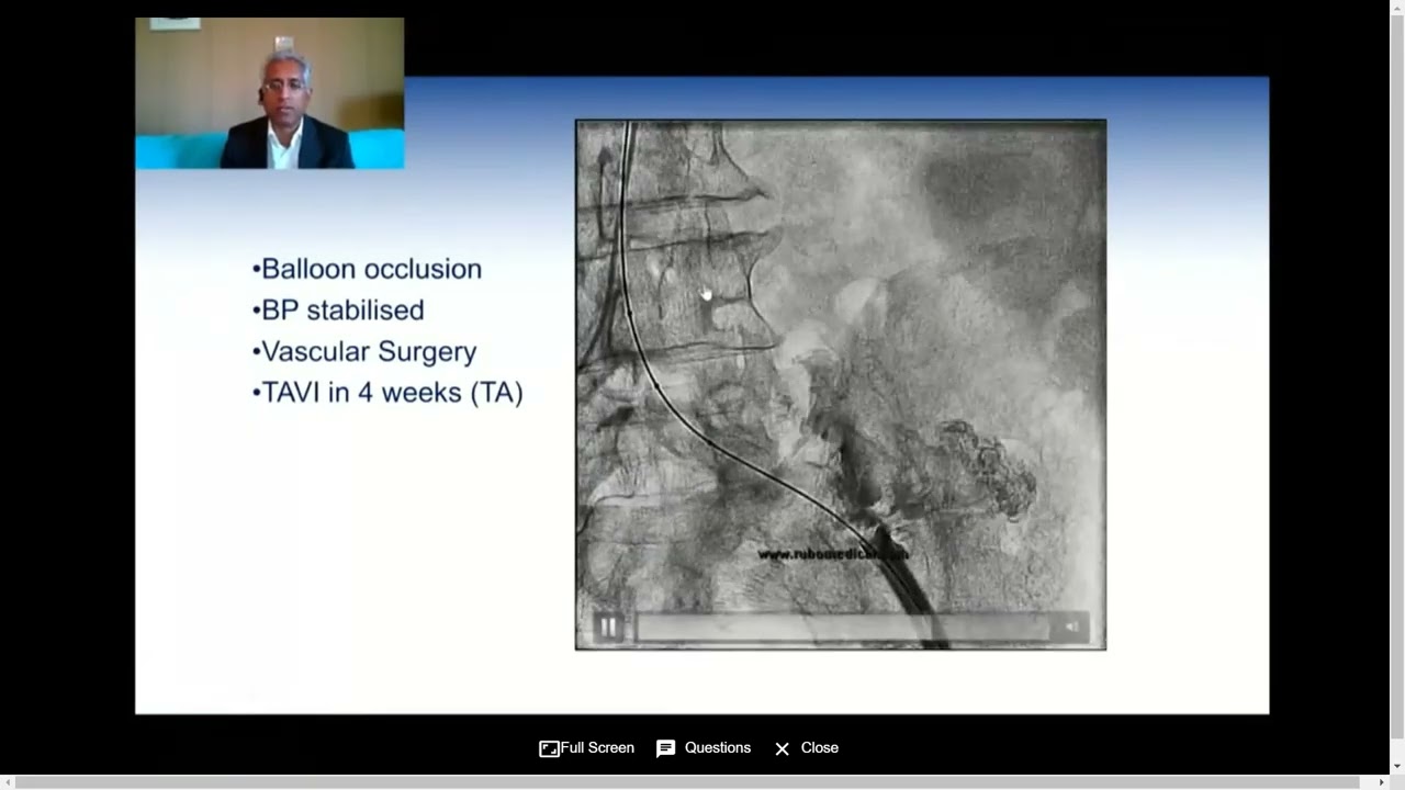 18 Complications of TAVI & How to Prevent Them