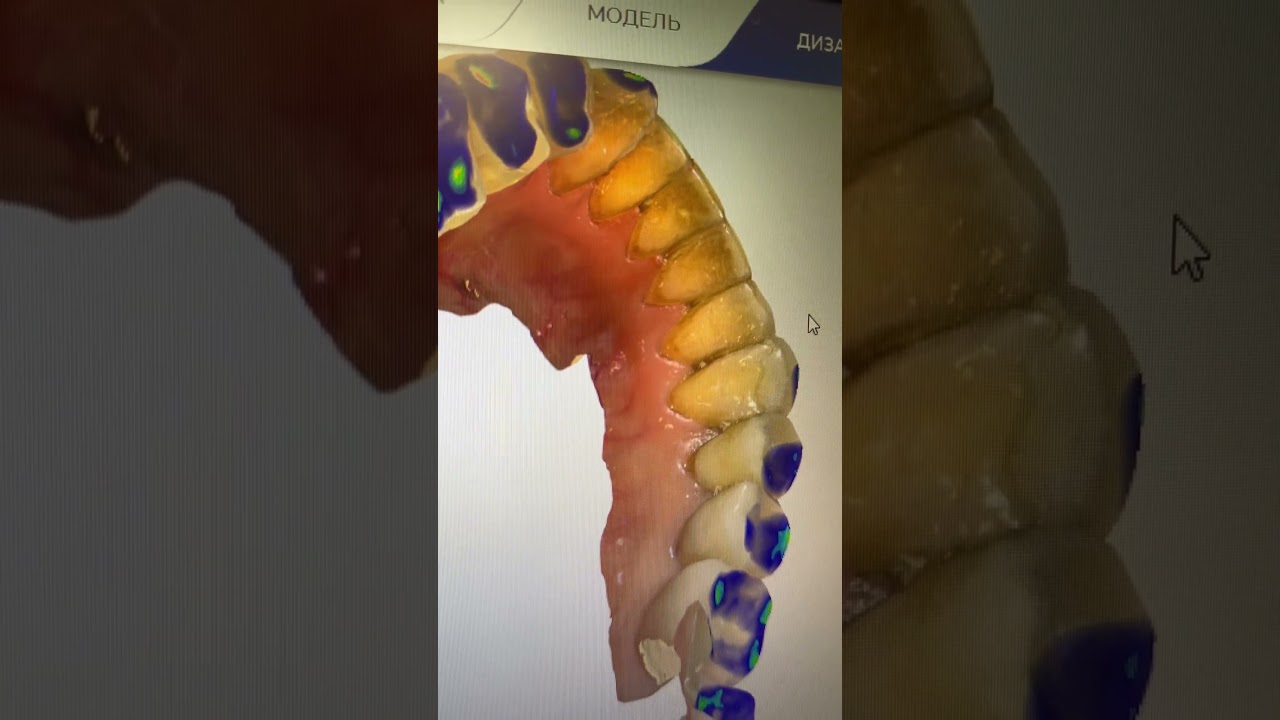 Секреты аккуратной профессиональной чистки зубов без повреждений!