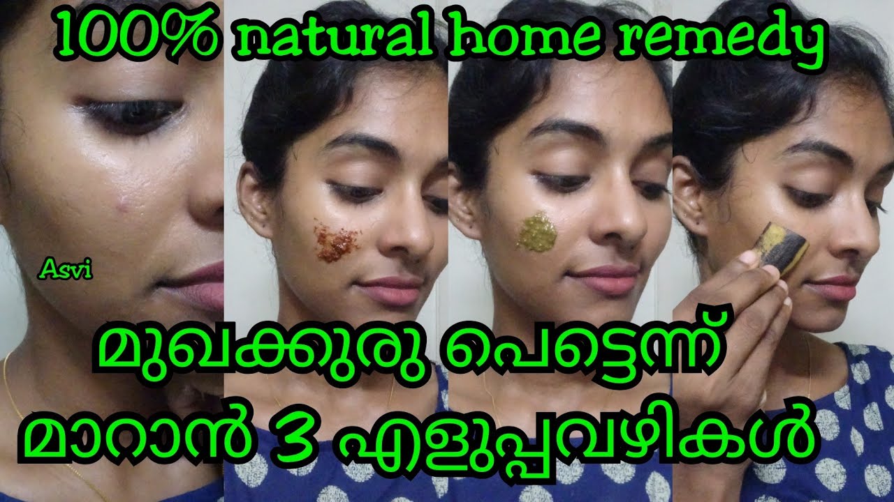 മുഖക്കുരു പെട്ടെന്ന് മാറാൻ 3 എളുപ്പവഴികൾ|100% natural remedy for both men & women|Asvi