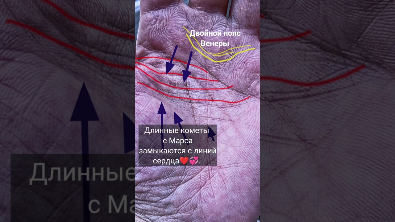 Внебрачные страсти. #хирология