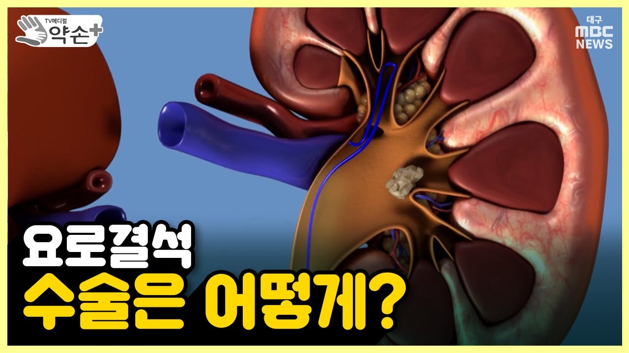 요로결석⑦ 수술은 어떻게? | 메디컬 약손