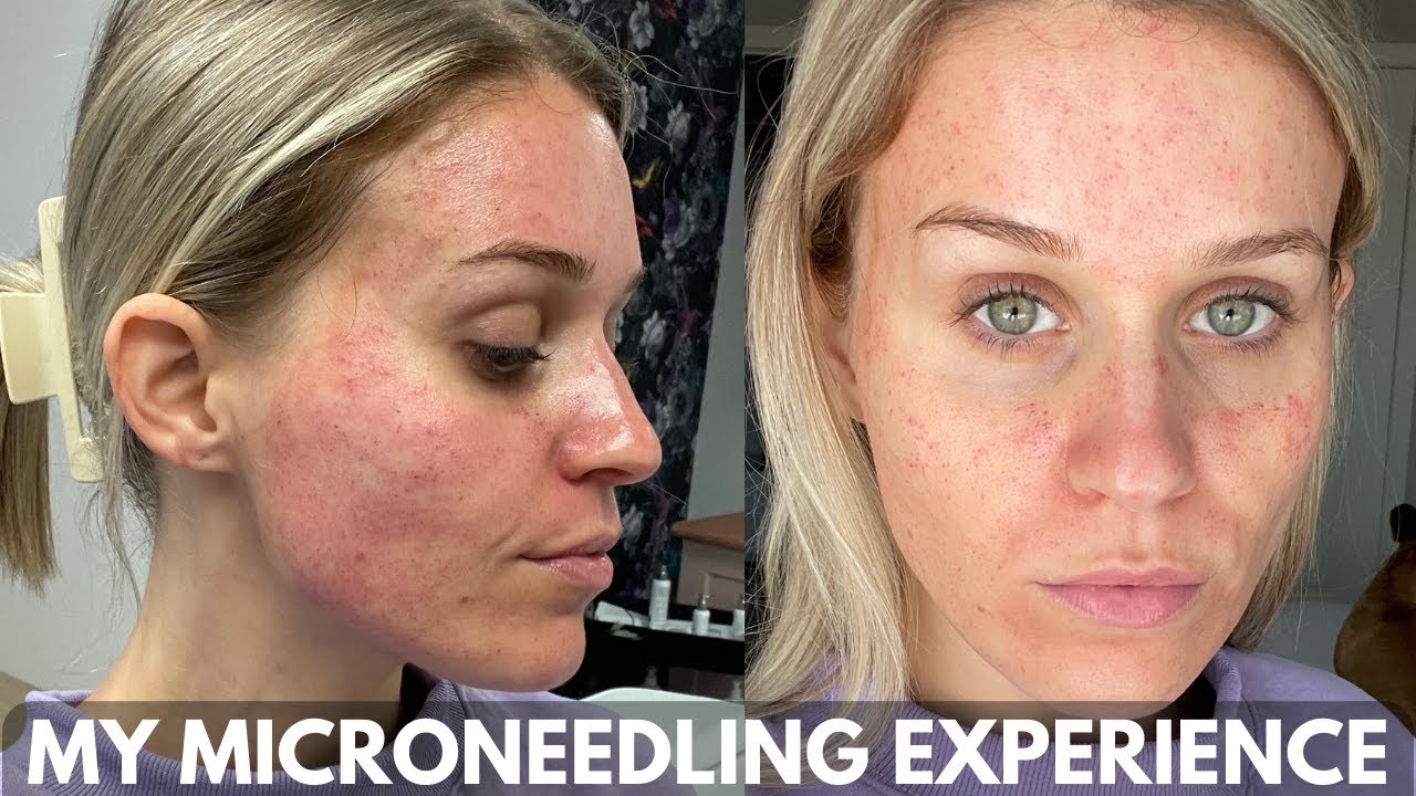 MY MICRONEEDLING EXPERIENCE & Full Week Healing Process