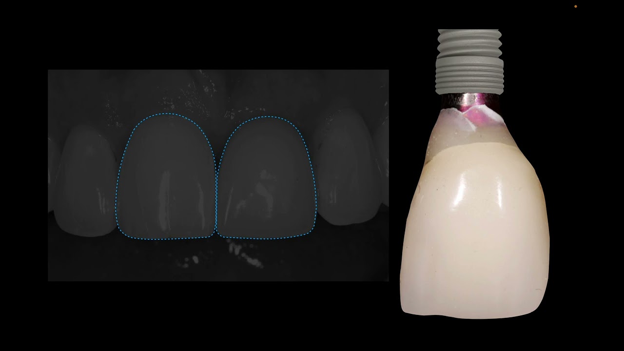Critical Contours for Tissue Manipulation in the Anterior Esthetic Zone