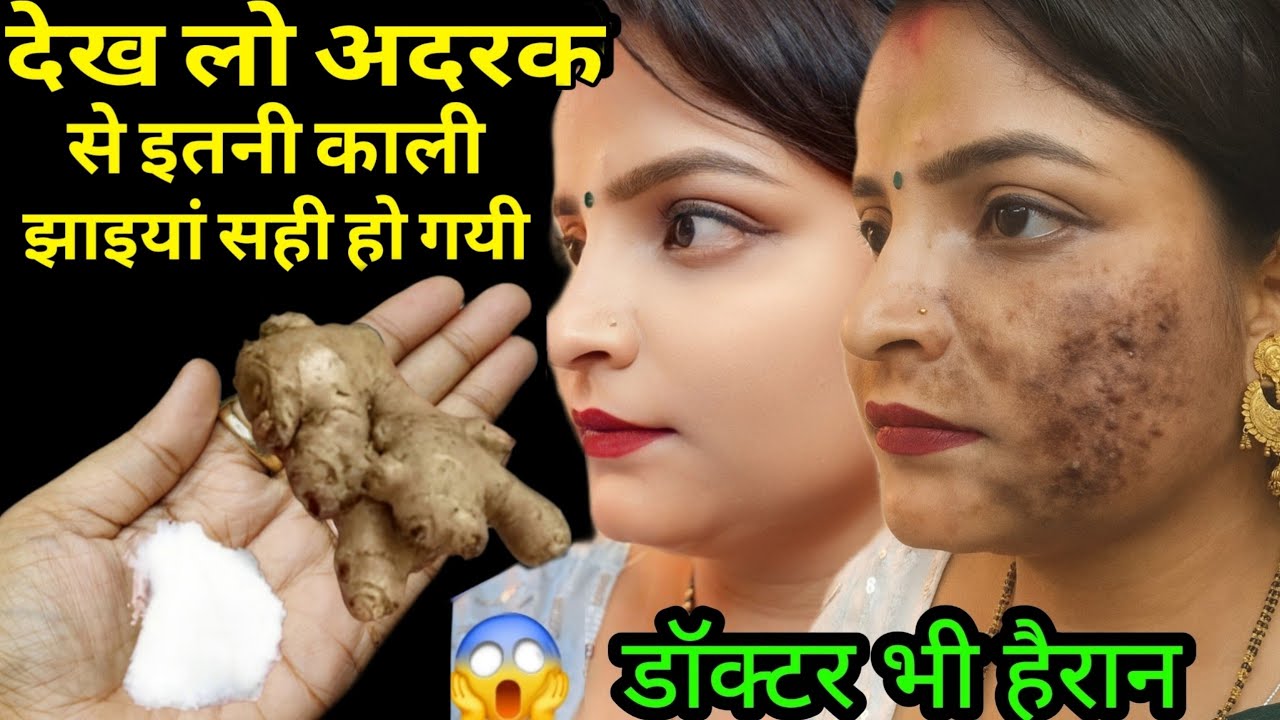 अदरक से झाइयां हटाने का कमाल का तरीका Reduce Melasma, Pigmentation, Discolouration Blackspots