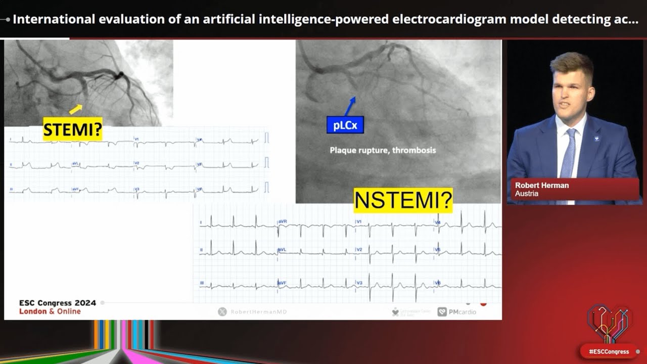 International evaluation of an AI-powered ECG model detecting acute coronary occlusion in MI | ESC