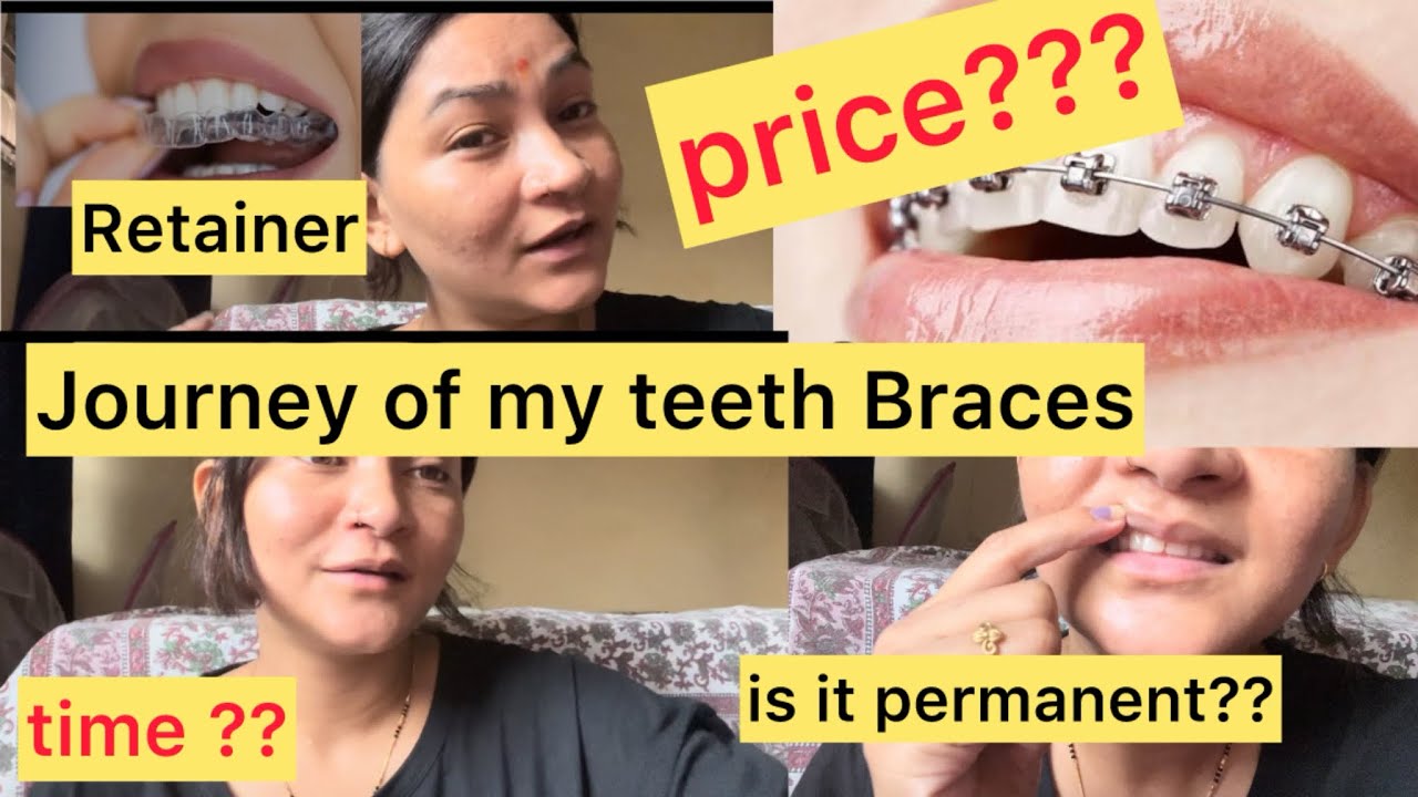 Watch my Braces journey…….A honest Review…….