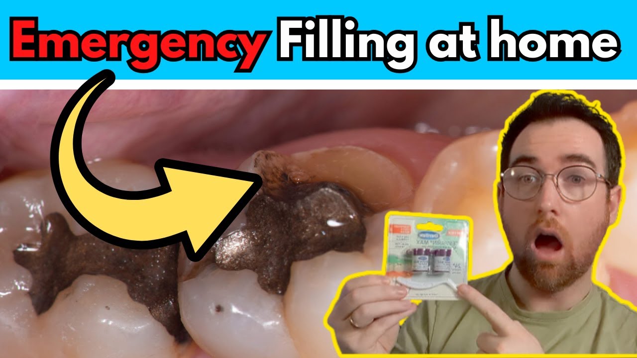 DIY Tooth filling: Using Temporary filling material at home