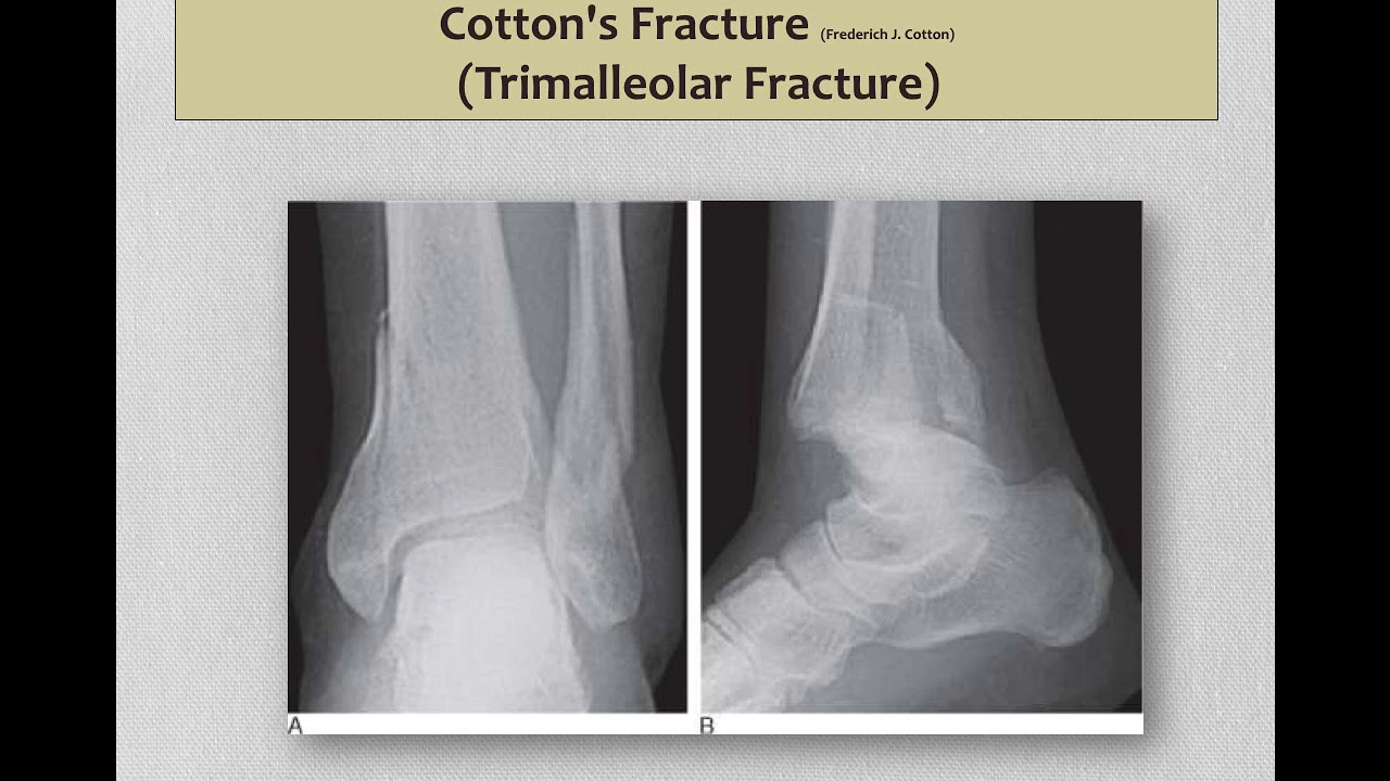 Lower Limb Fractures - Video No.10
