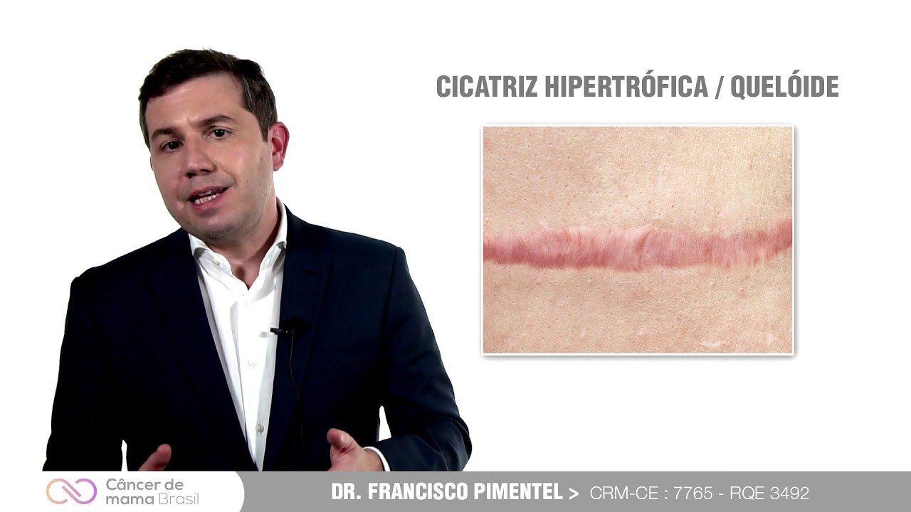 COMPLICAÇÕES DA CIRURGIA DO CÂNCER DE MAMA.