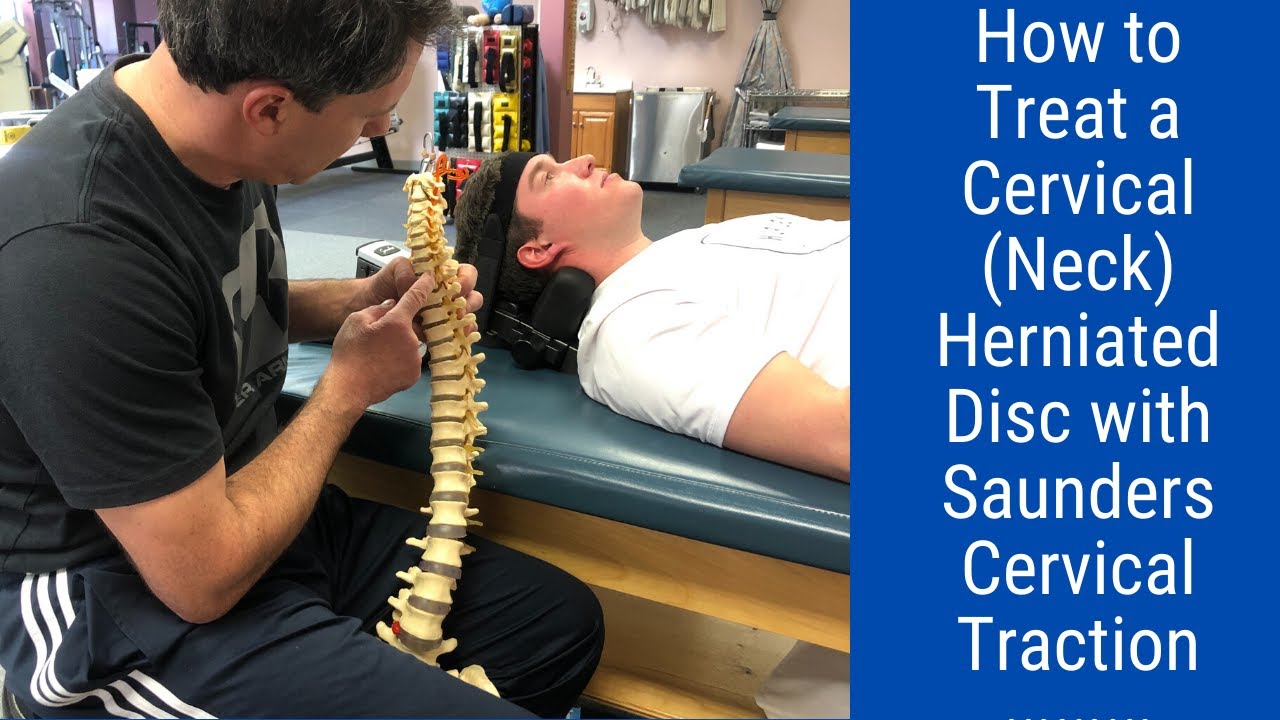 How to Treat a Cervical(Neck) Herniated Disc/Saunders Cervical Traction