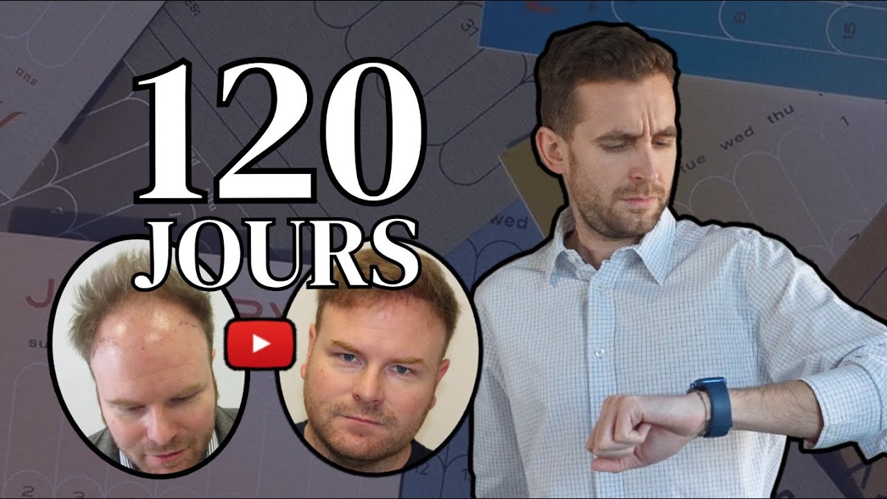 Voyez ce qui se passe 120 jours après une greffe de cheveux !