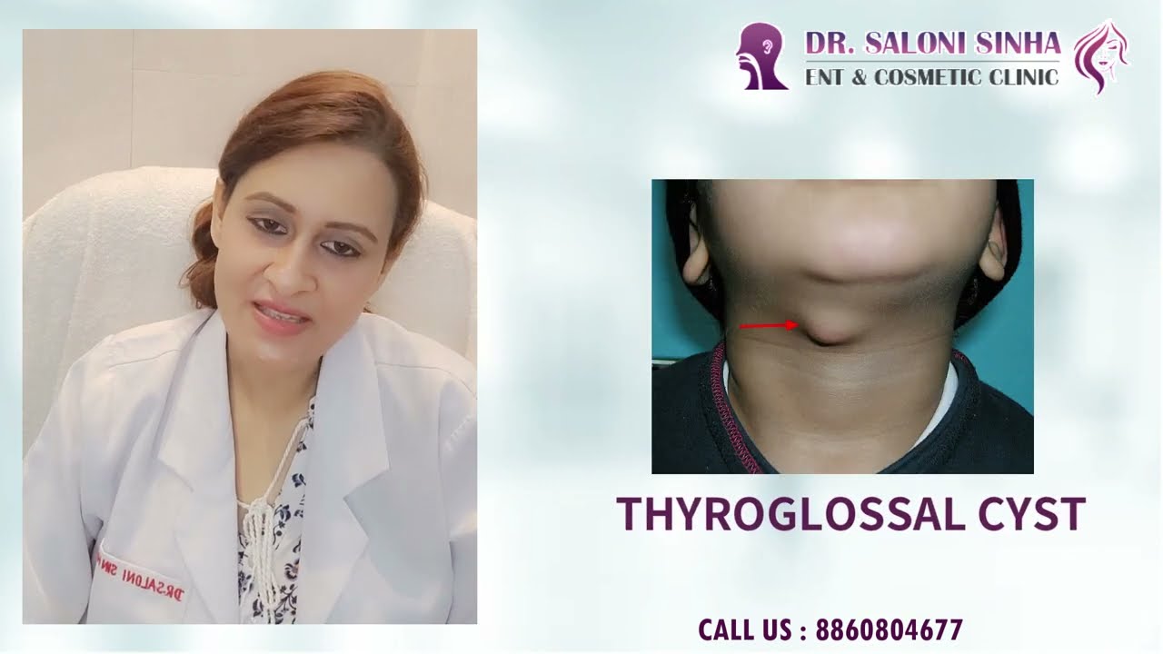 Neck Swelling /Dr.Saloni Sinha/Thyroglossal Cyst/Thyroglossal Fistula