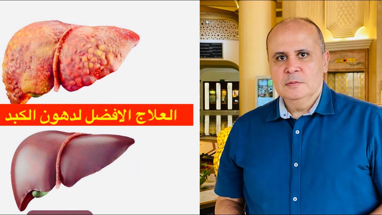 افضل علاج لدهون وتشحم الكبد الخطير بسبب السكر والضغط والدهون الثلاثيه